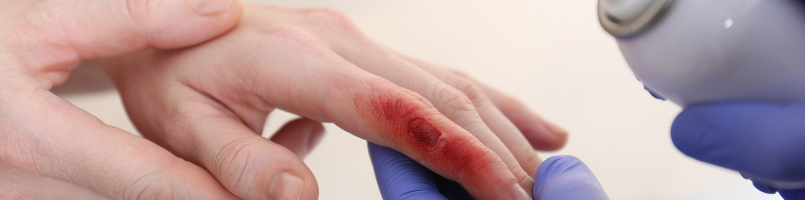 bigstock-Applying-Burn-Spray-Onto-Injur-409060709